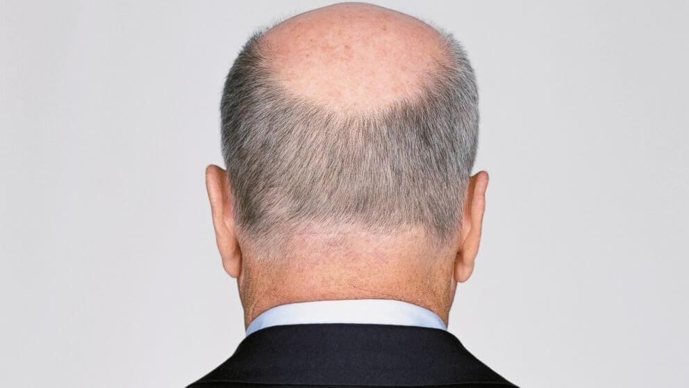 Propecia is used to handle male-pattern hair loss