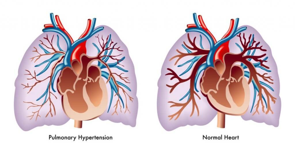 What is pulmonary arterial hypertension