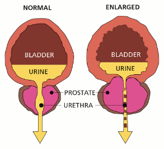 prostatic hyperplasia