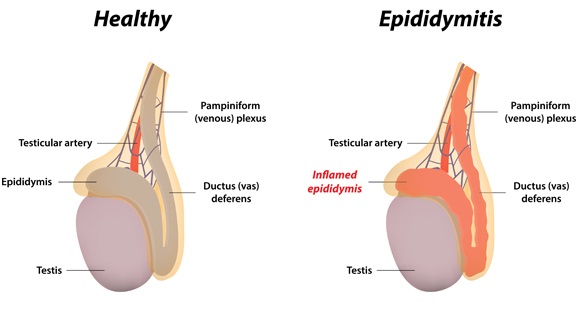 Inflammation of the epididymis