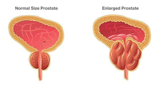 What are symptoms of benign prostatic hyperplasia