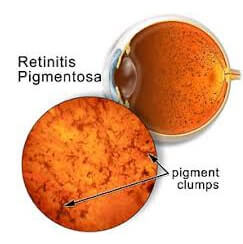 or pigmented retinitis